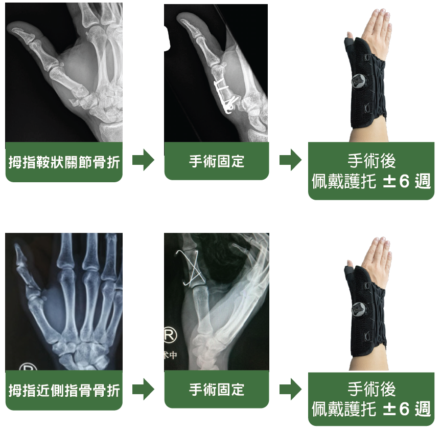 Thumb surgical treatment details